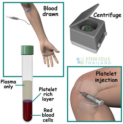 Plasma rico en plaquetas